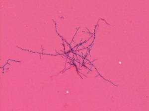 Gram stain of growth from the AFB bottle showing beaded, branch Gram positive bacilli. 