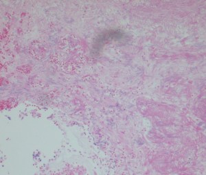 Lung tissue, area of necrosis; H&E stain, 10x 