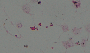 Gram stain showing Gram negative diplococci. 