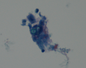 Bronchoalveolar lavage fluid (Pap stain). 