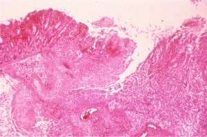 "Flask-shaped" ulcer in amoebiasis