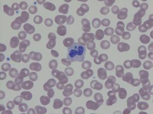 Blood smear showing granulocyte with intracytoplasmic morulae.