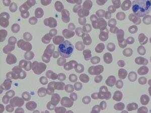 Blood smear showing granulocyte with intracytoplasmic morulae.