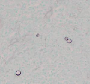 Silver stain of involved bone with fungal organisms exhibiting broad-based budding.
