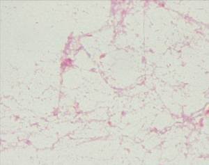 Gram stain shows Gram negative bacilli.