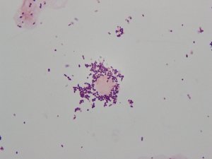 Gram stain of cerebral spinal fluid (CSF) specimen showing Gram postive cocci in singles and pairs