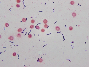 Gram stain of positive blood culture broth showing Gram positive cocci in chains