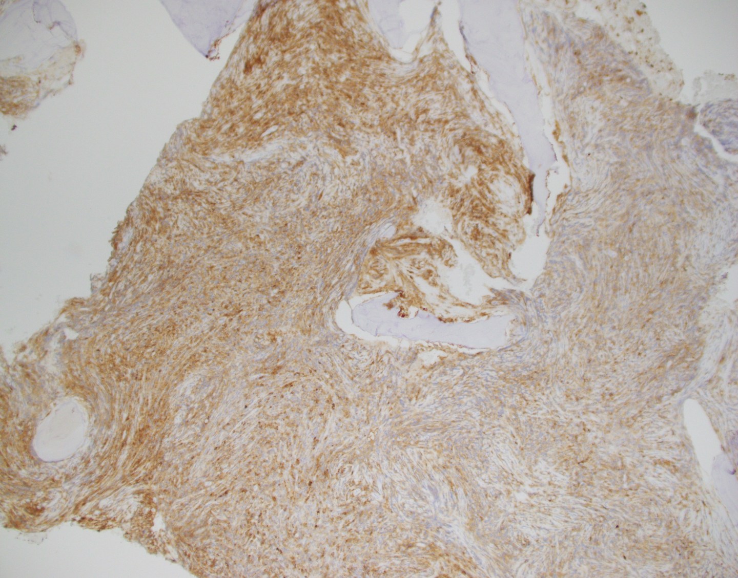 Hematopathology Case Study: A 72 Year Old Female with History of Lung ...