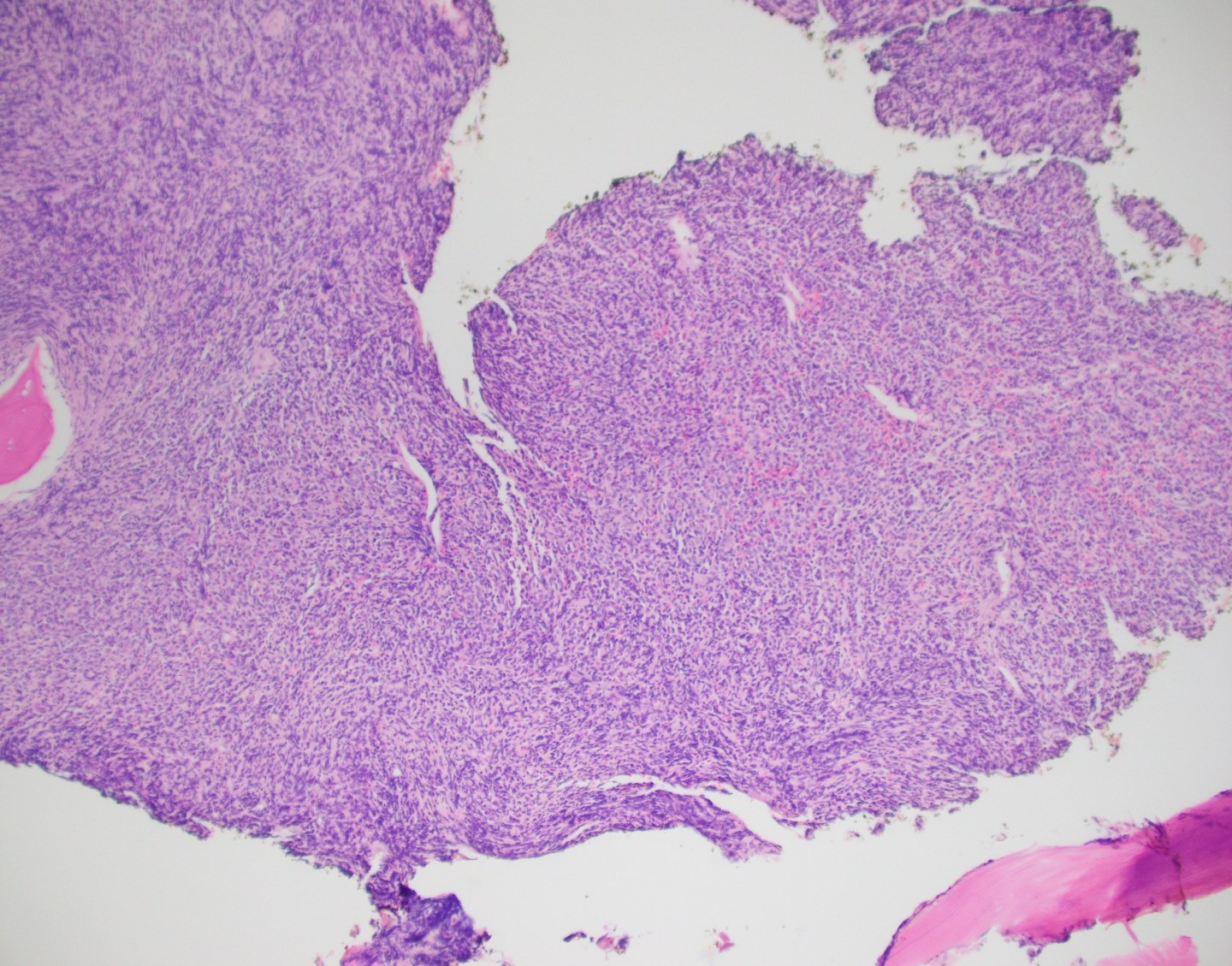 Hematopathology Case Study: A 72 Year Old Female with History of Lung ...