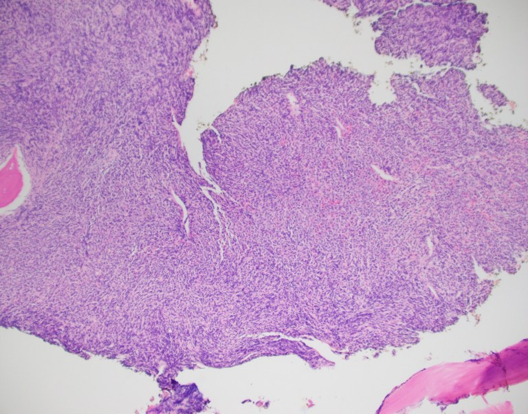 Hematopathology Case Study: A 72 Year Old Female with History of Lung ...