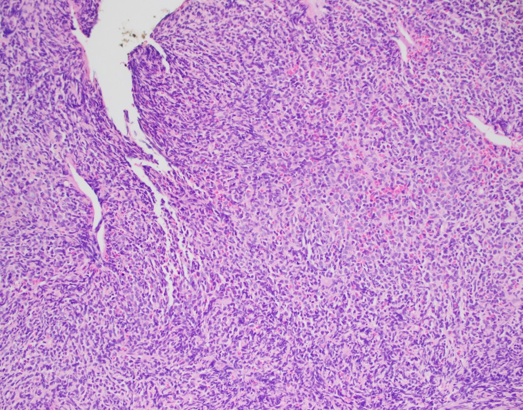 Hematopathology Case Study: A 72 Year Old Female with History of Lung ...