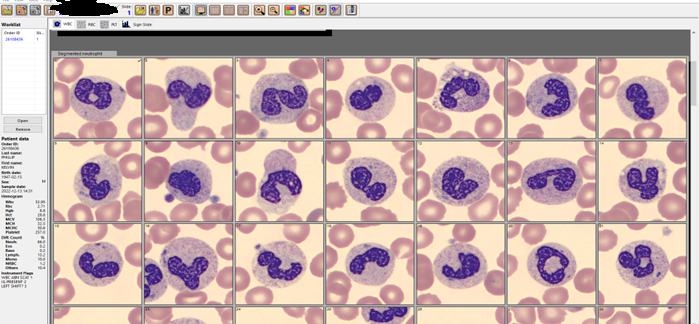 Band Vs Segmented Neutrophils Blood Film Band Vs Segmented Neutrophils Blood Film
