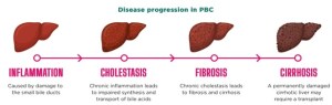 Pbc Radiographically Lablogatory – A blog for medical laboratory professionals